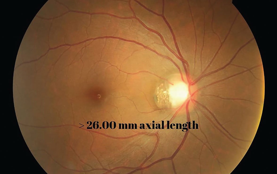 Fig. 4. Axial length of 26.00mm or greater  in children greatly increases their risk of eye disease in adulthood.