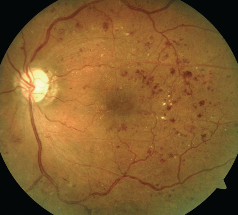 An example of moderately severe non-proliferative diabetic retinopathy. Using ERG testing in such a patient, neural damage may be detectable.