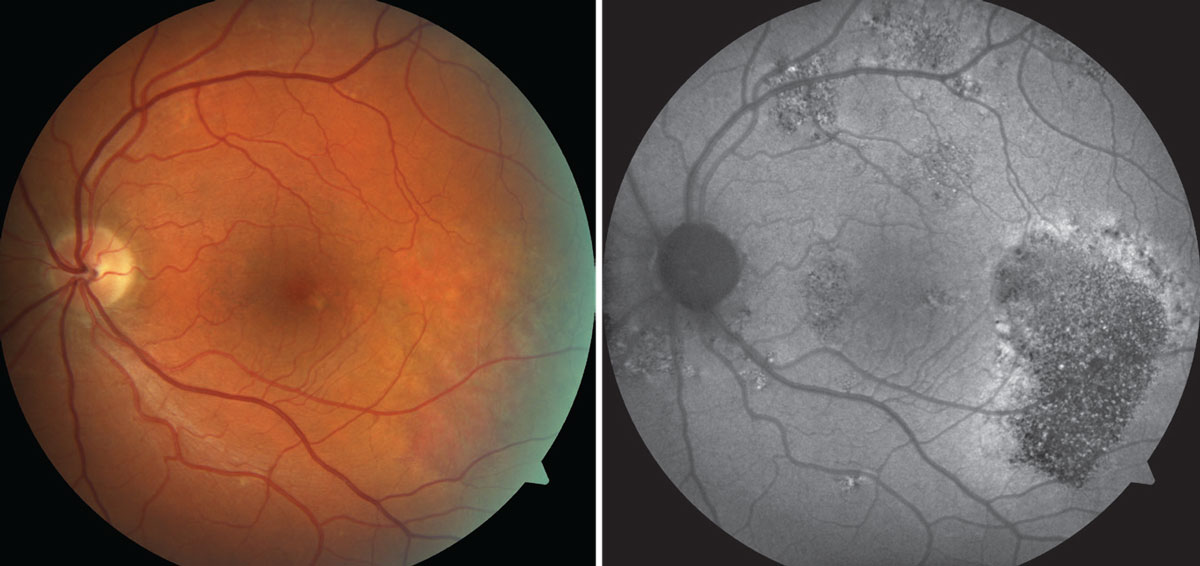 FAF dramatically reveals clinical evidence of central serious chorioretinopathy in this case.