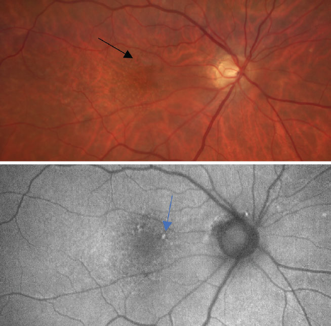 At top, a color photo of early, dry AMD with a few small drusen (<63µm) and mild RPE changes as defined by the Age-Related Eye Disease Study (black arrow). At bottom, an FAF photo that shows small areas of hyperfluorescence and highlights the RPE changes caused by an increase of drusen (blue arrow).