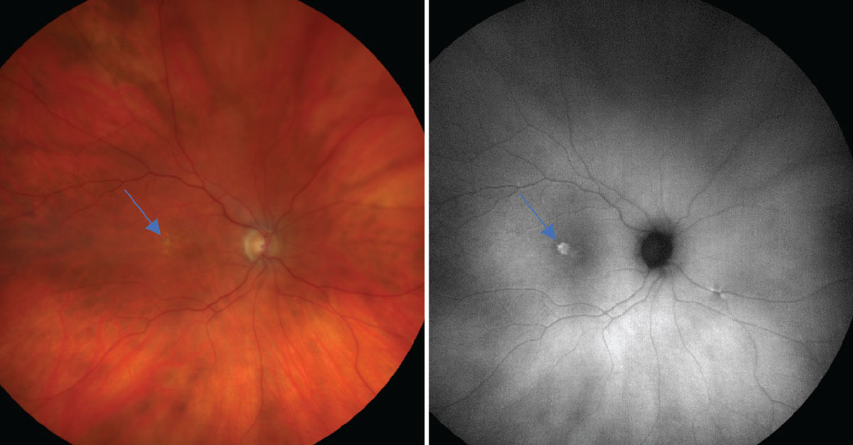 On the left is a color photo of early AMD with a few soft drusen (~63µm), mild RPE changes (as defined by the Age-Related Eye Disease Study) and a new, elevated lesion temporal to the macula (blue arrow). On the right is an FAF photo that shows a significant amount of hyperfluorescence associated at the site of this new lesion, suggesting the presence of a choroidal neovascular membrane from increased metabolic activity.