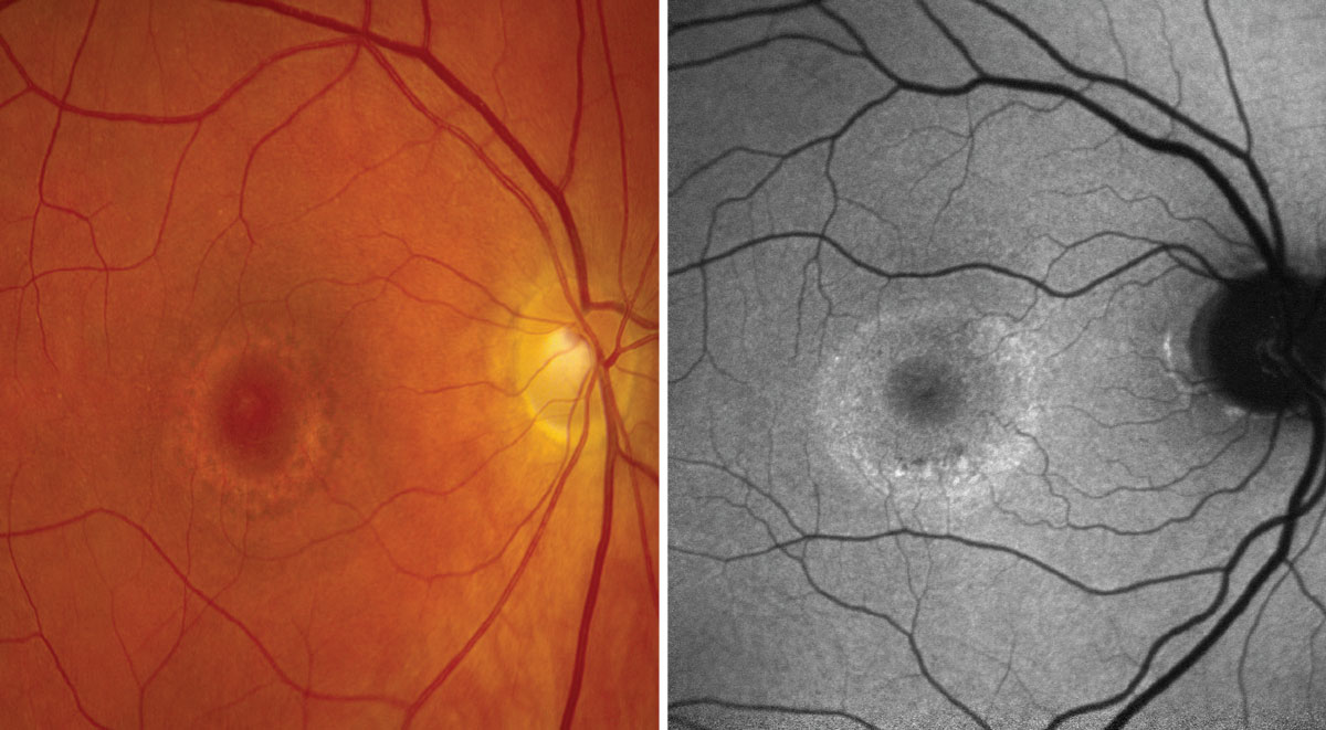 On the left, a color photo showing parafoveal pigmentary changes in a bull’s eye pattern. On the right, FAF shows a large ring of hyperfluorescence surrounding the macula, indicative of active cell death.
