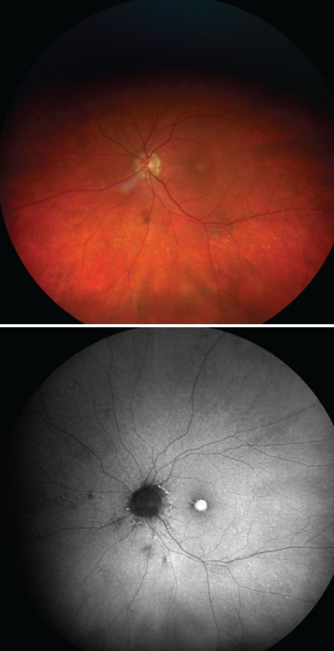 On top, a color photo captures a large, central yellow-ish lesion consistent with the appearance of a vitelliform lesion. On the bottom, the FAF photo captures a large area of hyperfluorescence at the site of the lesion from highly concentrated lipofuscin.