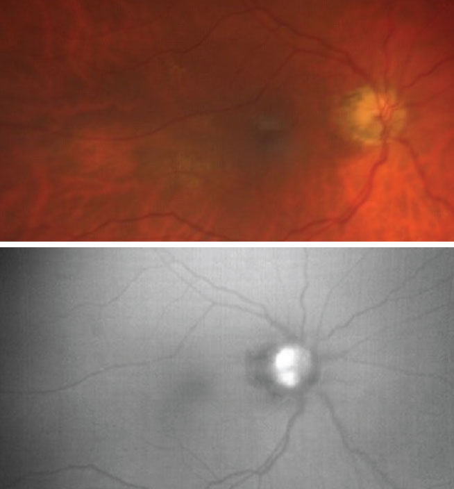 The top color photo captures an optic nerve head with indistinct margins and is suspected for visible ODD. On the bottom, the FAF photo reveals multiple ODD as highlighted by the increased FAF signal overlying the optic nerve head.