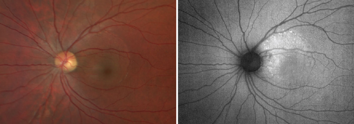 On the left, the color photo captures a large, round area of edema that is consistent with CSCR. On the right, the FAF photo highlights an increased area of hyperfluorescence caused by photoreceptor debris from subretinal fluid accumulation.