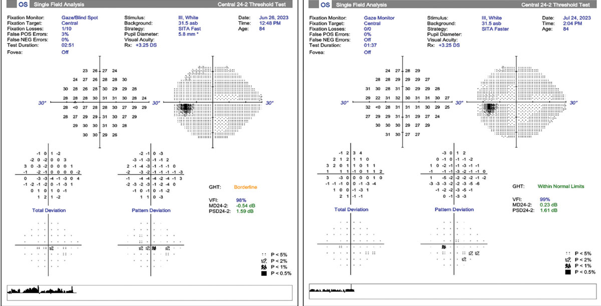 Fig. 2. Two examples of 24-2 visual fields of a patient with ocular hypertension Left: SITA Fast field shows good reliability with low fixations losses, low false-positives and a borderline glaucoma hemifield test. There is a small inferior central cluster defect questionable for early glaucoma. Right: One-month follow-up using SITA Faster shows no fixations losses, no false-positives and a glaucoma hemifield test within normal limits. The field does not confirm the previous central defect but reveals a shallow inferior nasal cluster defect.