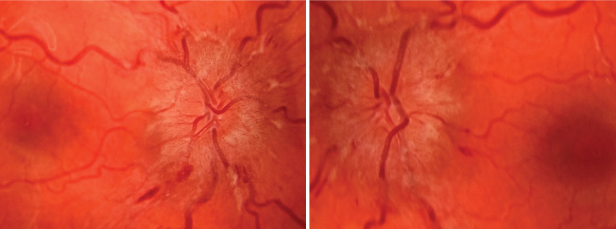 Topcon fundus photo of optic nerve OD at presentation (left). Topcon fundus photo of optic nerve OS at presentation (right).