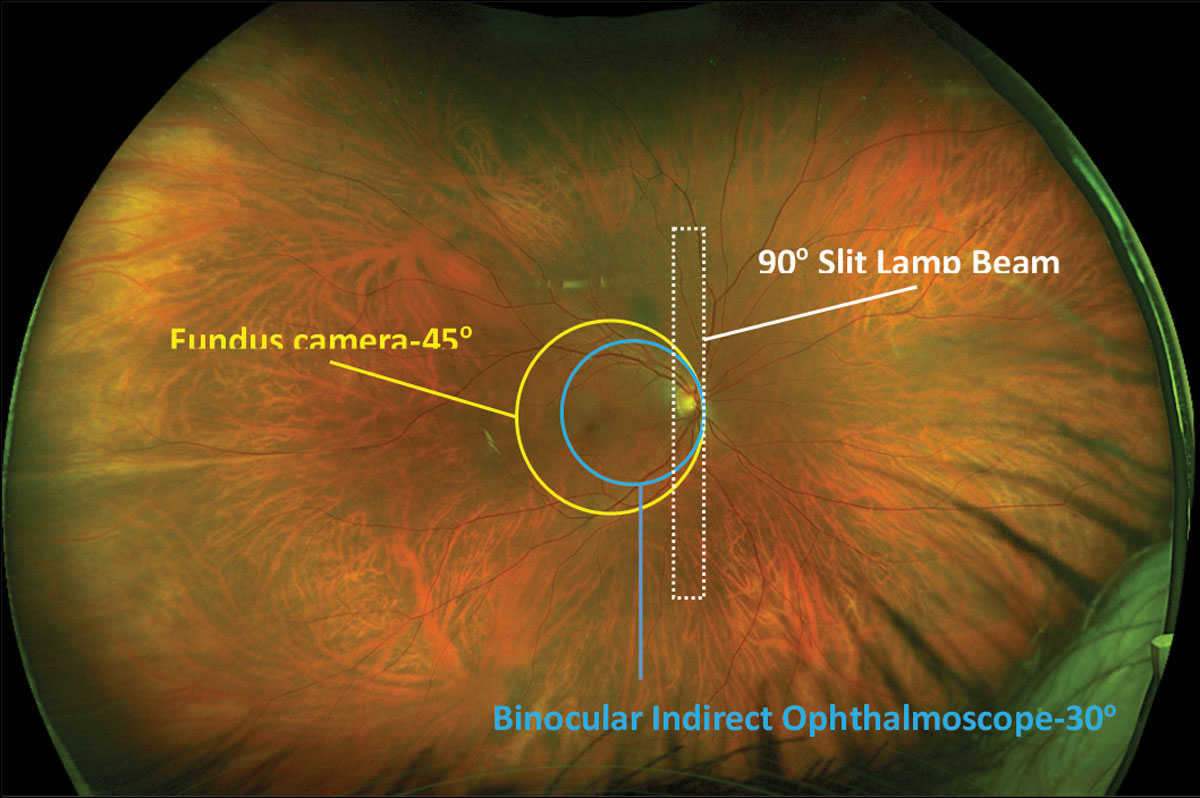 Fig. 1. Comparisons of fields of view from different fundus imaging devices overlaid on an Optos photo.