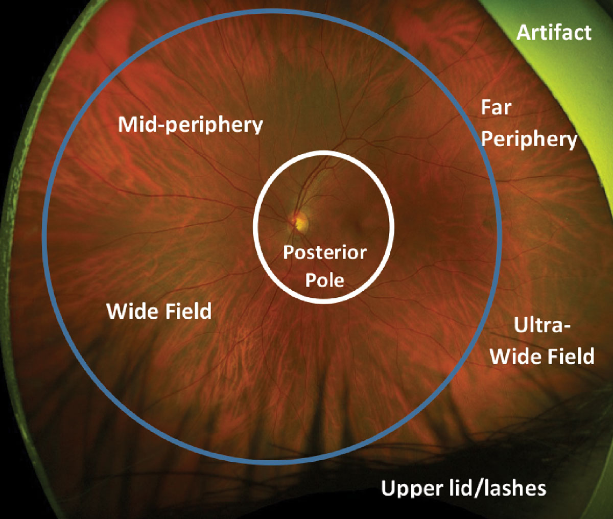 Fig. 2. Defining widefield and ultra-widefield on an Optos photo. The white circle represents the posterior pole of the fundus. The retina inside the blue circle represents widefield imaging and mid peripheral retina. The retina outside the blue circle represents ultra-widefield imaging and the far periphery.