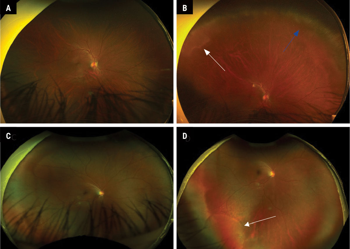 Fig. 3. (A) Normal-appearing Optos fundus photo in straight-ahead gaze. (B) Steered photo of patient A, looking up to reveal peripheral cystoid degeneration (blue arrow) and white without pressure (white arrow). (C) Normal-appearing Optos fundus photo in straight-ahead gaze. (D) Steered photo of patient C, looking down and out to reveal a shallow inferior temporal retinal detachment (white arrow).