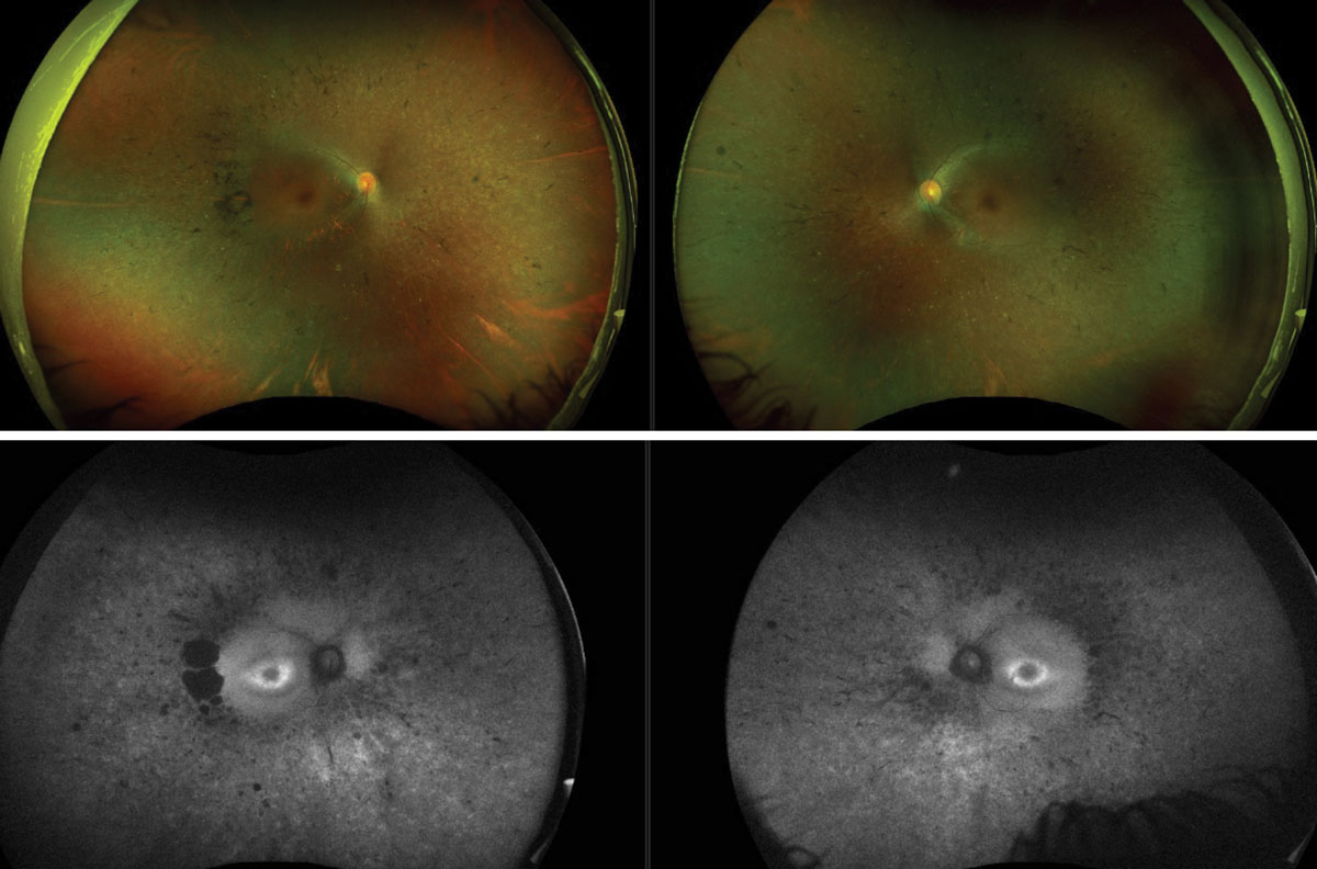 Fig. 4. Color Optos photos of retinitis pigmentosa (top). FAF Optos images of the same patient (bottom).