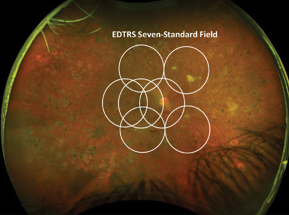 Fig. 5. EDTRS seven-standard field images laid over an Optos proliferative diabetic retinopathy photograph.