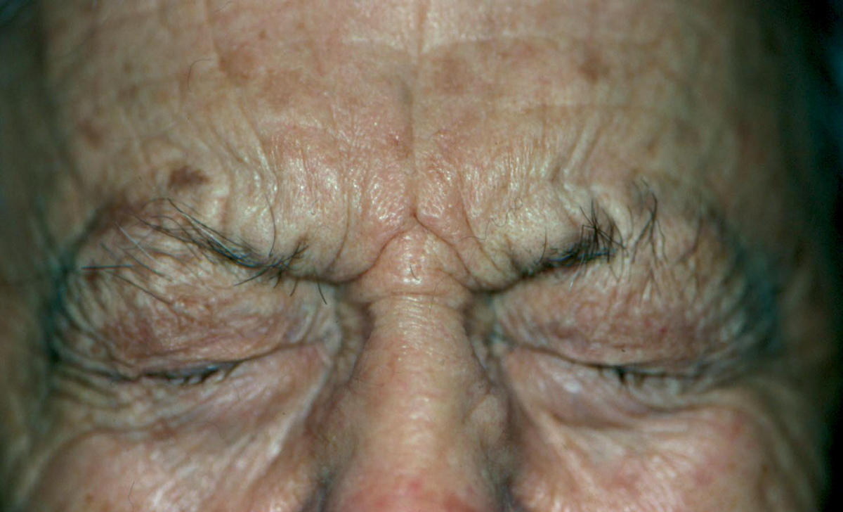 Fig. 1. BEB, a common bilateral facial dystonia, involves the orbicularis oculi, procerus and corrugator musculature.