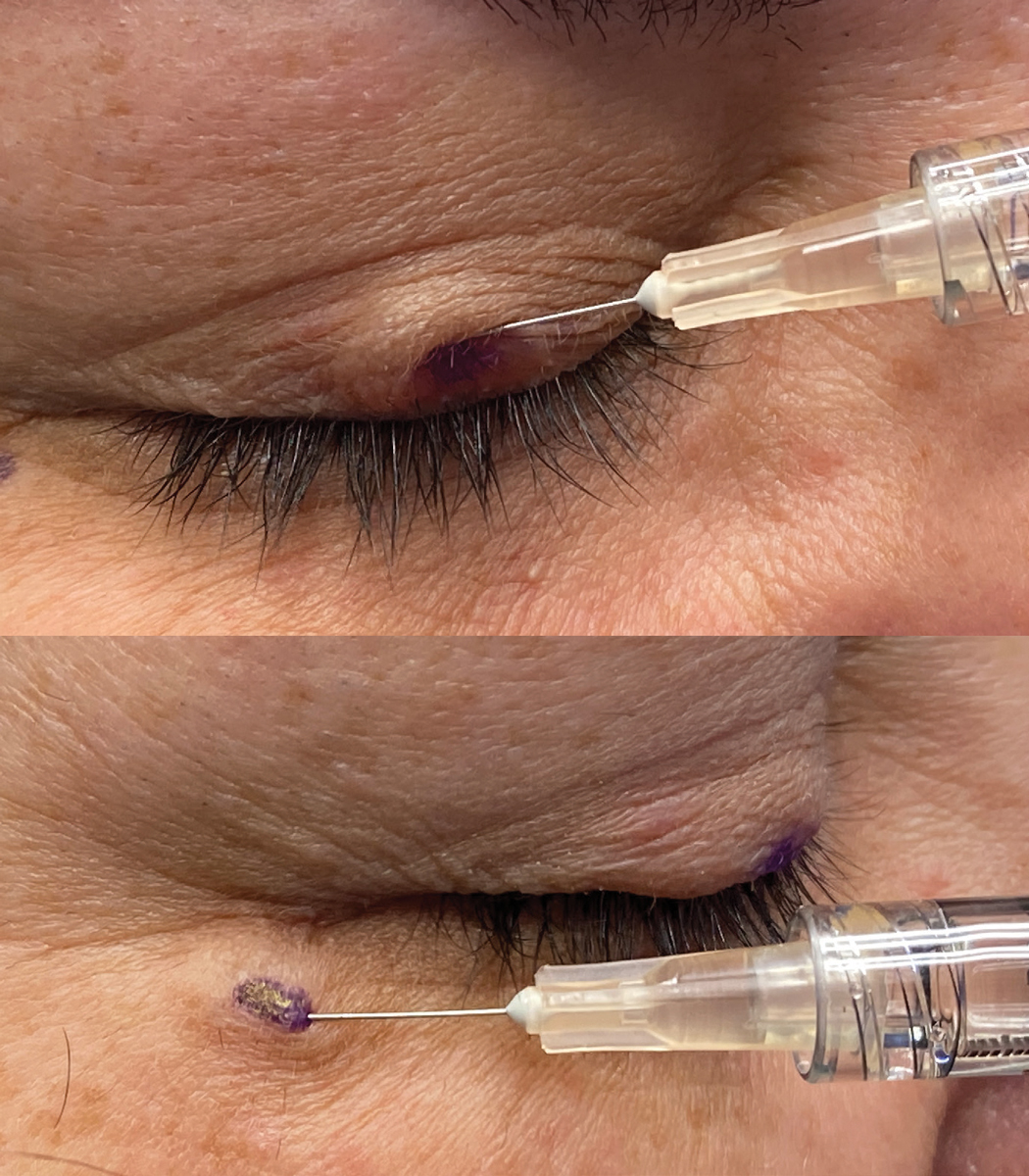 Figs. 4 and 5. At top, injection of botox in the central upper lid in the pretarsal portion of the orbicularis. A 30-gauge needle on a 1cc syringe is being used. At bottom, injection of botox along the temporal aspect of the orbicular muscle. Notice the shallow approach of the needle to the injection site and the wheal of medication being injected very superficially just below the skin.