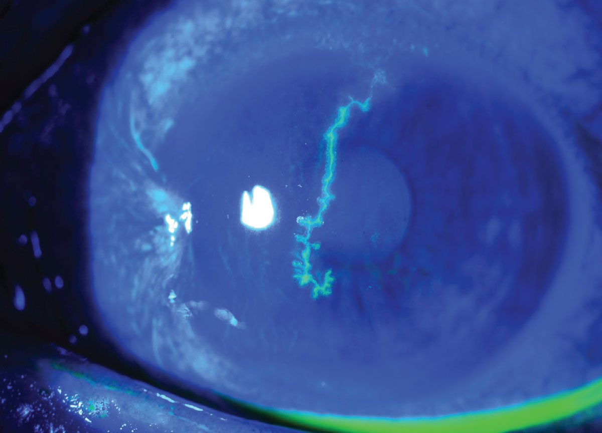 A 54-year-old man with a history of a pterygium in this eye presented with a large central HSV dendrite. It was treated with oral valacyclovir and resolved. He has been maintained on prophylactic oral valacyclovir to prevent recurrences, especially as this dendrite was so large and central.