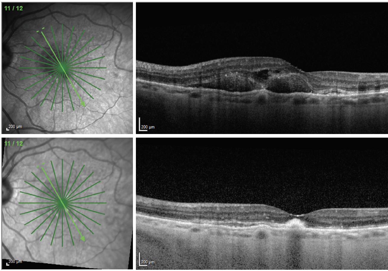 Fig. 1. An 83-year-old female presented with nAMD and 20/400 visual acuity (top). She received an injection of Eylea and returned four weeks later with significant improvement in macular thickness (bottom). Her visual acuity was still 20/200 at this visit. The patient will continue to receive injections, and the visual outcome will depend on how much submacular scarring and photoreceptor atrophy is present once the macula stabilizes. 