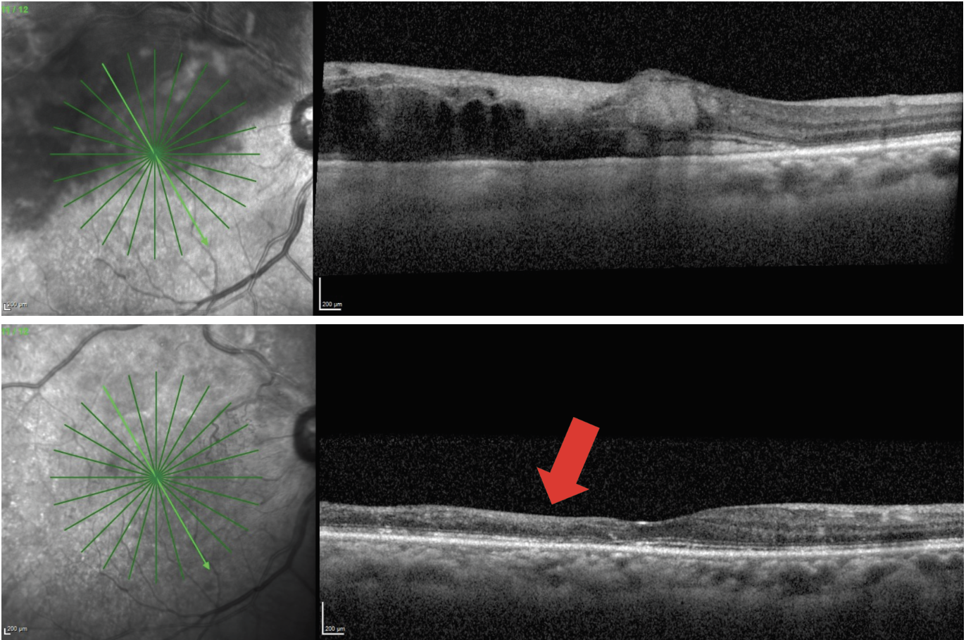 Fig. 2. A 68-year-old male patient presented with macular edema secondary to branch RVO and visual acuity of 20/80 (top). The patient had four monthly Avastin injections, which resulted in complete resolution of the macular edema (bottom). The patient’s visual acuity improved to 20/50 but was limited by the severity of macular ischemia that is evident from the significant inner retinal thinning (red arrow).