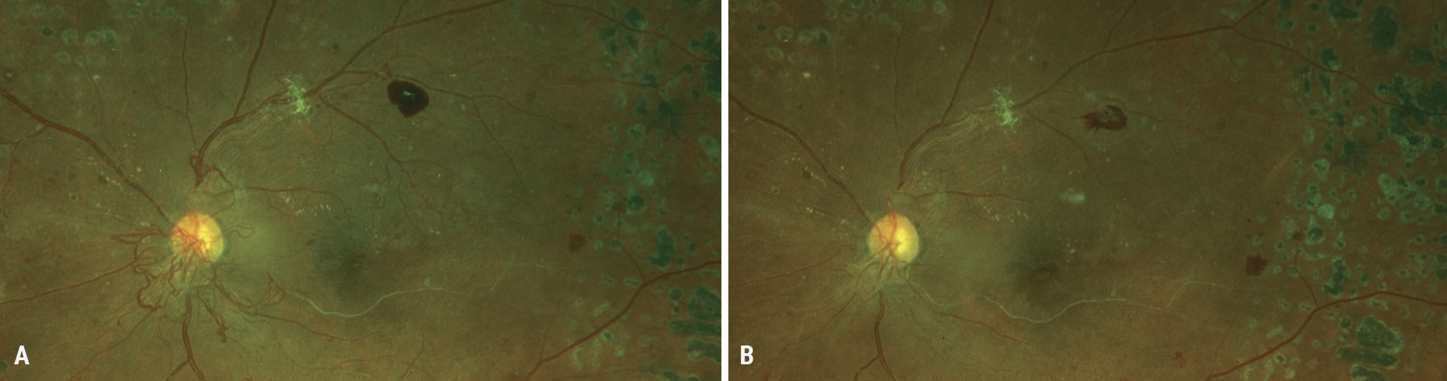Fig. 3. (A) A 40-year-old Black female presented after noncompliance with significant neovascularization at the disc (NVD). She has previously been treated with panretinal photocoagulation. She received an Avastin injection and returned one month later with resolution of the NVD (B). The patient must be compliant with follow-ups, as the neovascularization can return and require the need for more injections. 