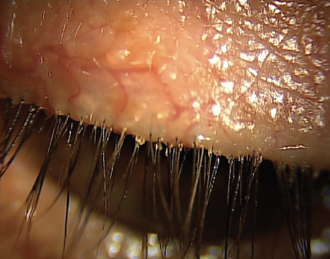 Debris at the base of the lashes is a hallmark sign of Demodex blepharitis.