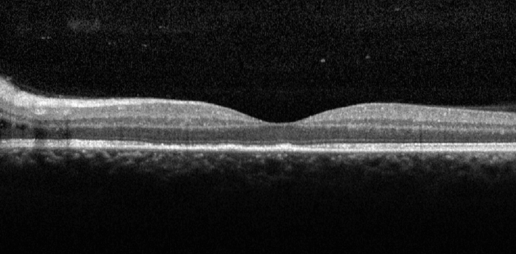 Fig. 4. OCT of the macula of the left eye showing loss of ellipsoid zone and intraretinal edema adjacent to the optic nerve.