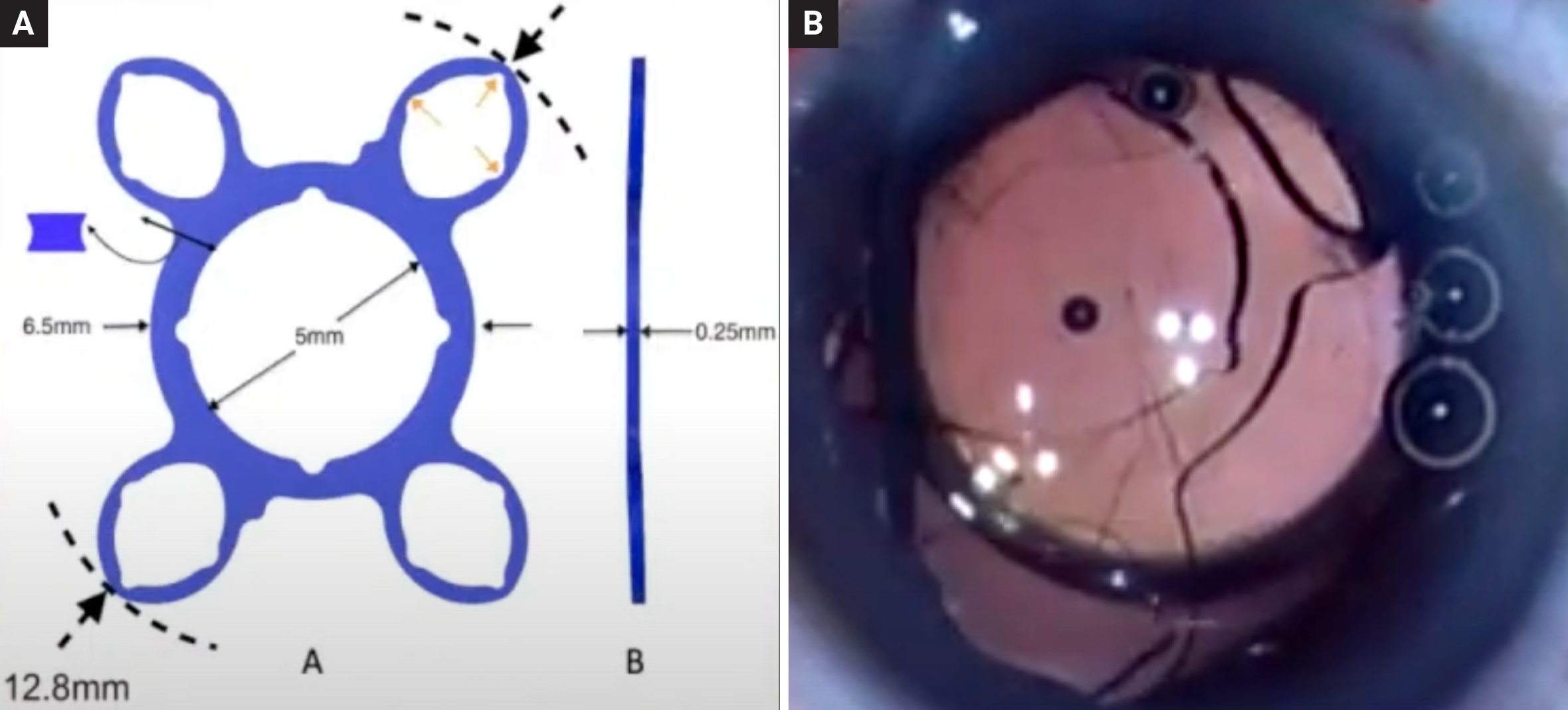 The ND Ring, which is not yet available in the US, may help clinicians avoid common issues encountered with other intraoperative solutions. Figure A shows a diagram of the design and Figure B presents an intraoperative view of it during implantation.