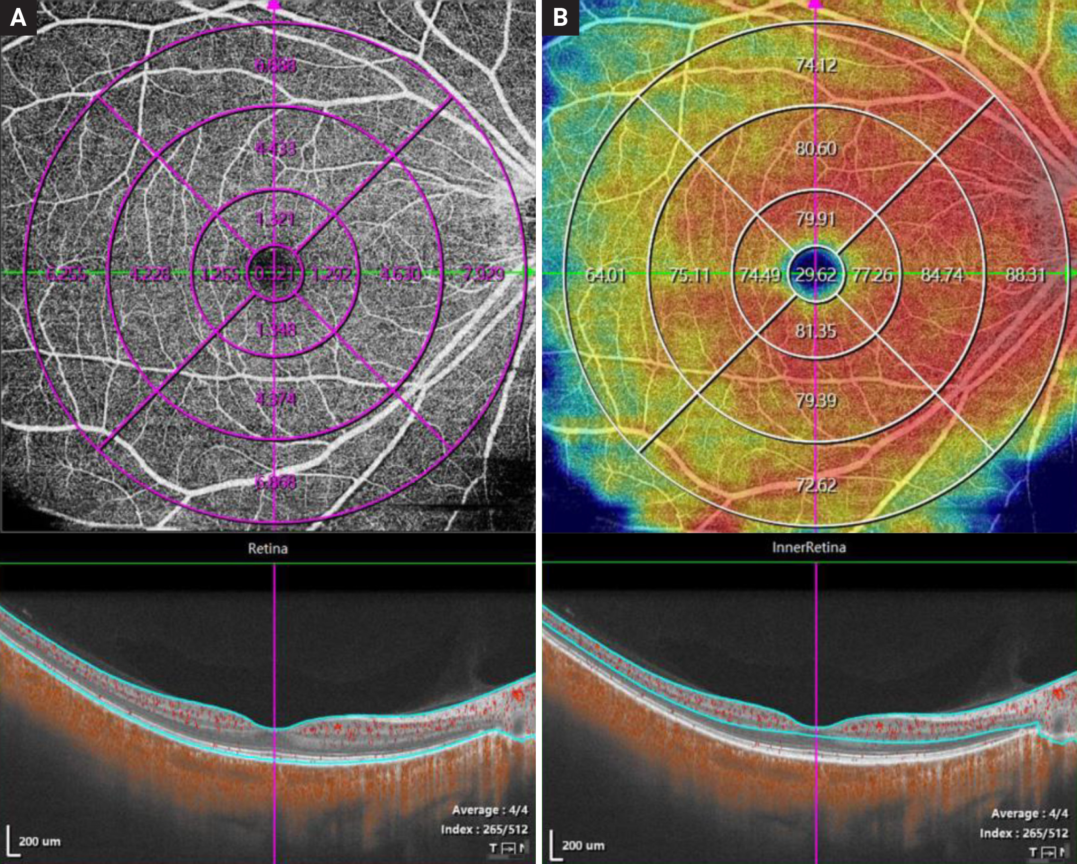 This study was able to correlate changes in flow area (A) and vessel density (B) on OCT-A with fundus changes on ultra-widefield imaging in myopes with varying disease severities.