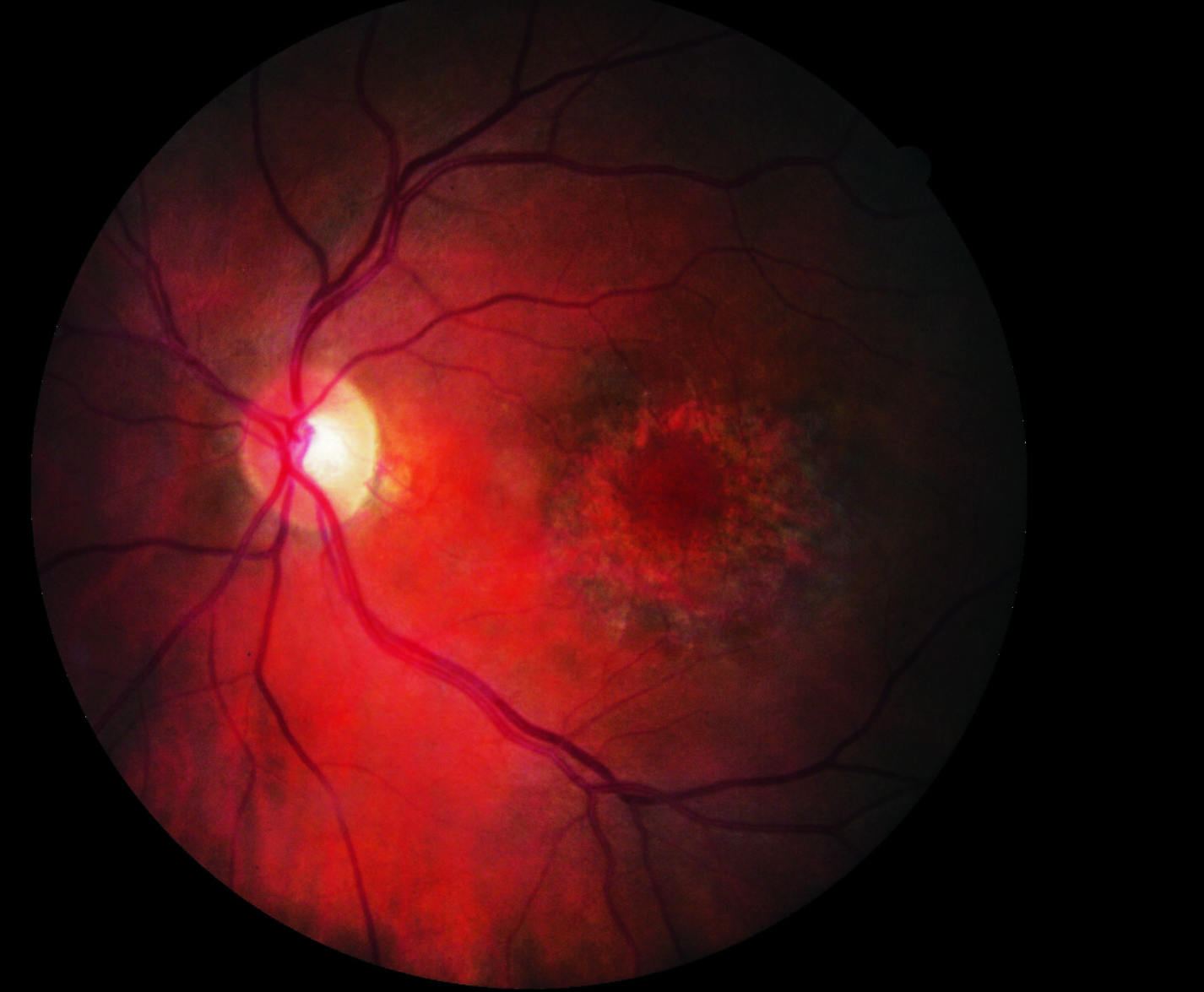 Choroidal volume, vascularity index and luminal volume were significantly lower in patients on hydroxychloroquine, which could be an early indicator of choroidal toxicity.