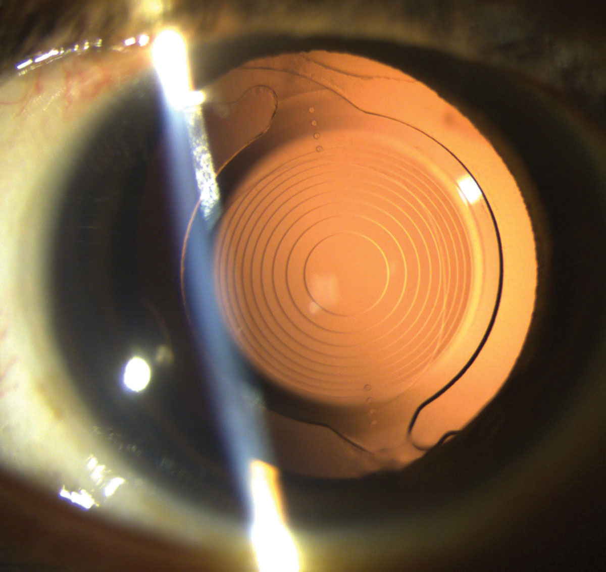 Experts say it’s reasonable to have a “selective” approach to NSAID use after cataract surgery. High-risk patients, such as those with advanced glaucoma, may benefit more from NSAIDs alone to help avoid steroid induced IOP increases.