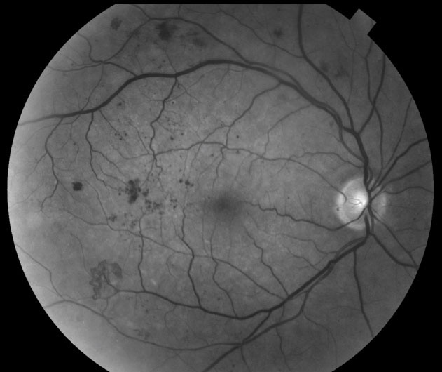 Clinicians might need to consider diabetes as a risk factor in patients affected by wet AMD during anti-angiogenic treatment.