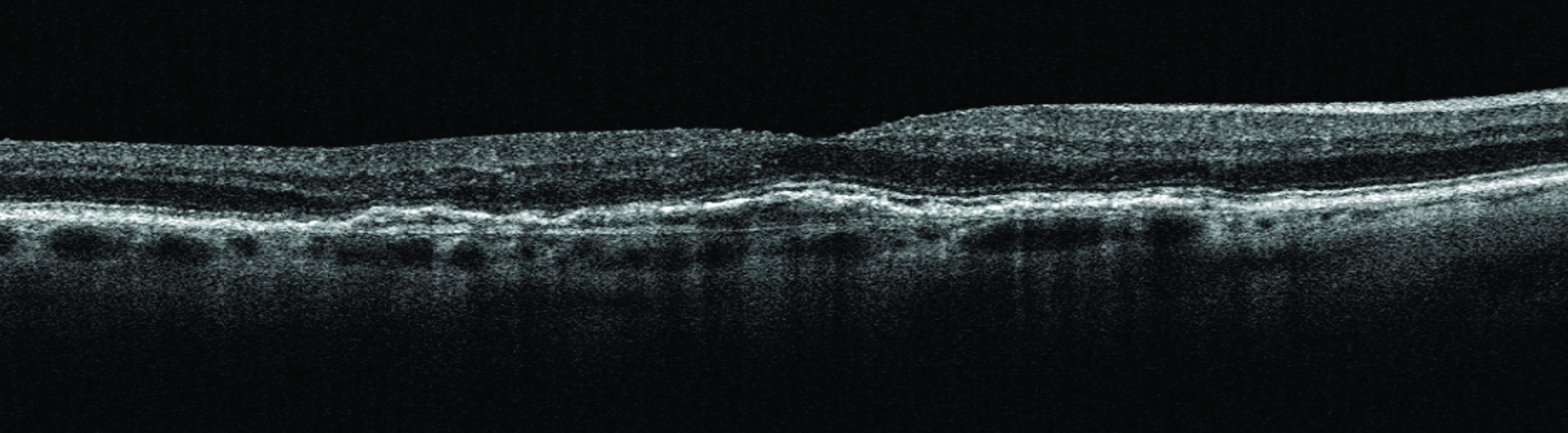 SD-OCT imaging shows the highest rate of progression was in eyes with the double layer sign, while shallow irregular RPE elevation—a derivative of DLS—does not increase hazard of progression.