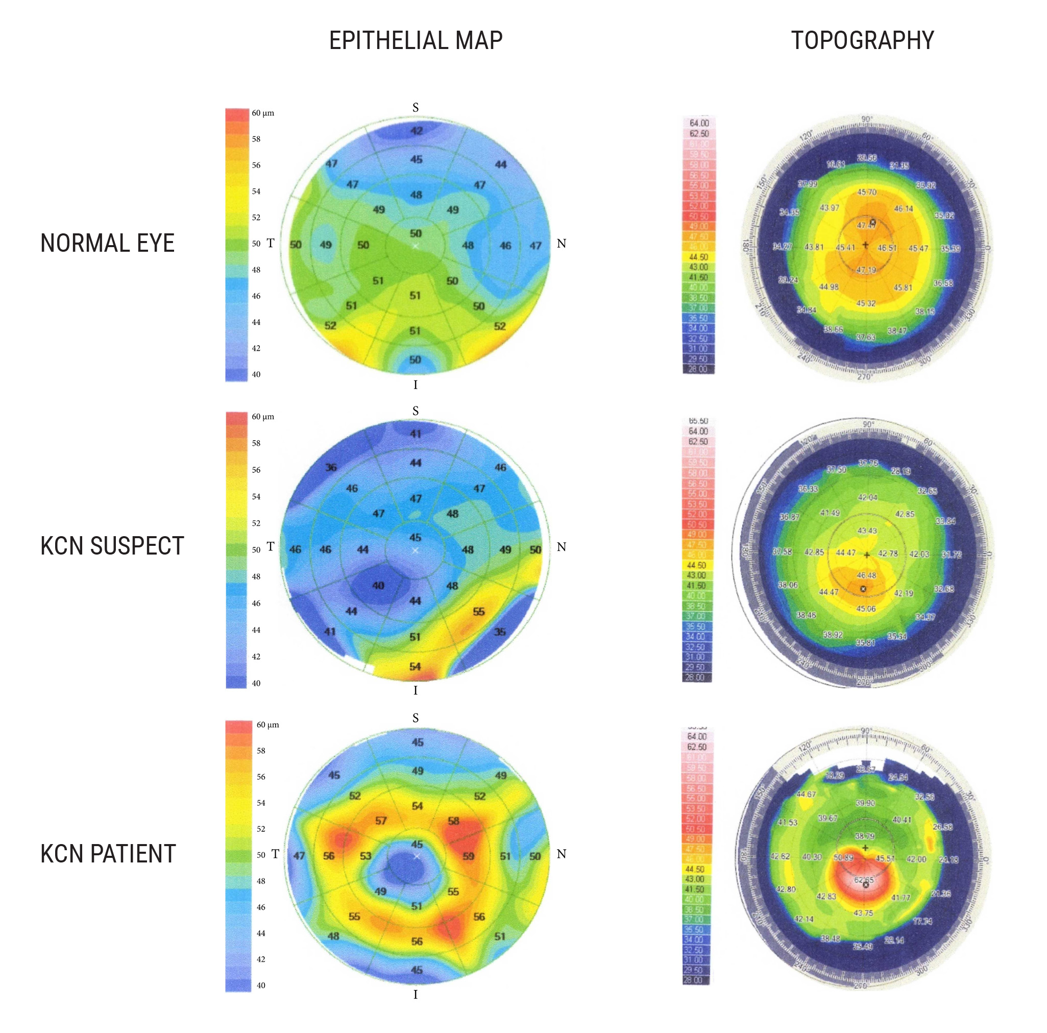 To strengthen the ability of OCT-derived data to detect subclinical keratoconus, researchers suggest that coupling epithelial thickness profiles with corneal tomography may prove beneficial in future studies.