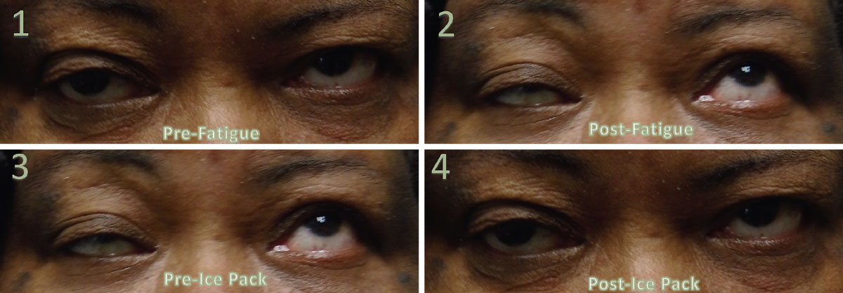 Fig. 2. These images represent a positive fatigue and ice pack test. Image 1 was taken prior to the fatigue testing. Image 2 was taken after two minutes of sustained up gaze. There was >2mm difference in the right palpebral aperture, indicating a positive test. Note the positive test occurred while up gaze was sustained. Image 3 depicts after fatigue testing, but prior to ice pack testing. Image 4 is after ice pack testing and is a positive result, as there is >2mm difference in the right palpebral aperture.