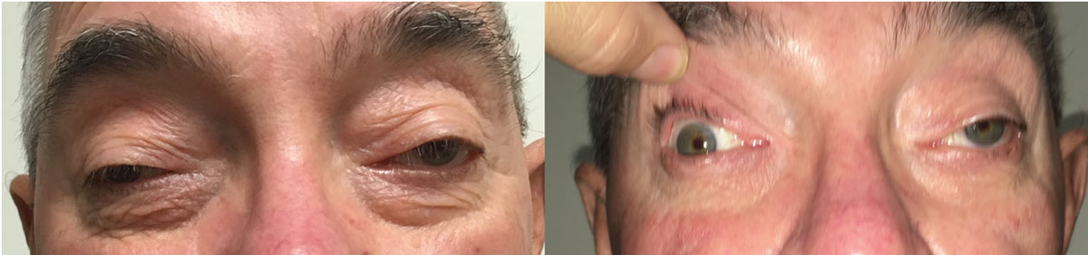 Fig. 3. This photo represents a patient with chronic progressive external ophthalmoplegia. At left, he is looking in primary gaze without his lids held. At right, he is in primary gaze with lids held.