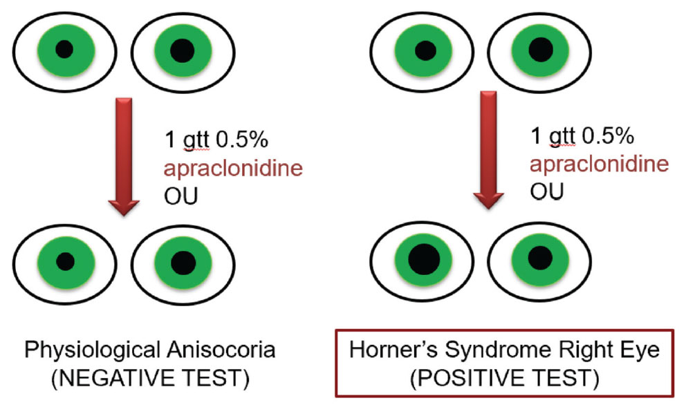 Fig. 4. A negative and positive response to 0.5% apraclonidine as related to the diagnosis of Horner’s syndrome. In a positive result, anisocoria are expected to reverse with 0.5% apraclonidine, while in a negative result, there will be no reversal of anisocoria.