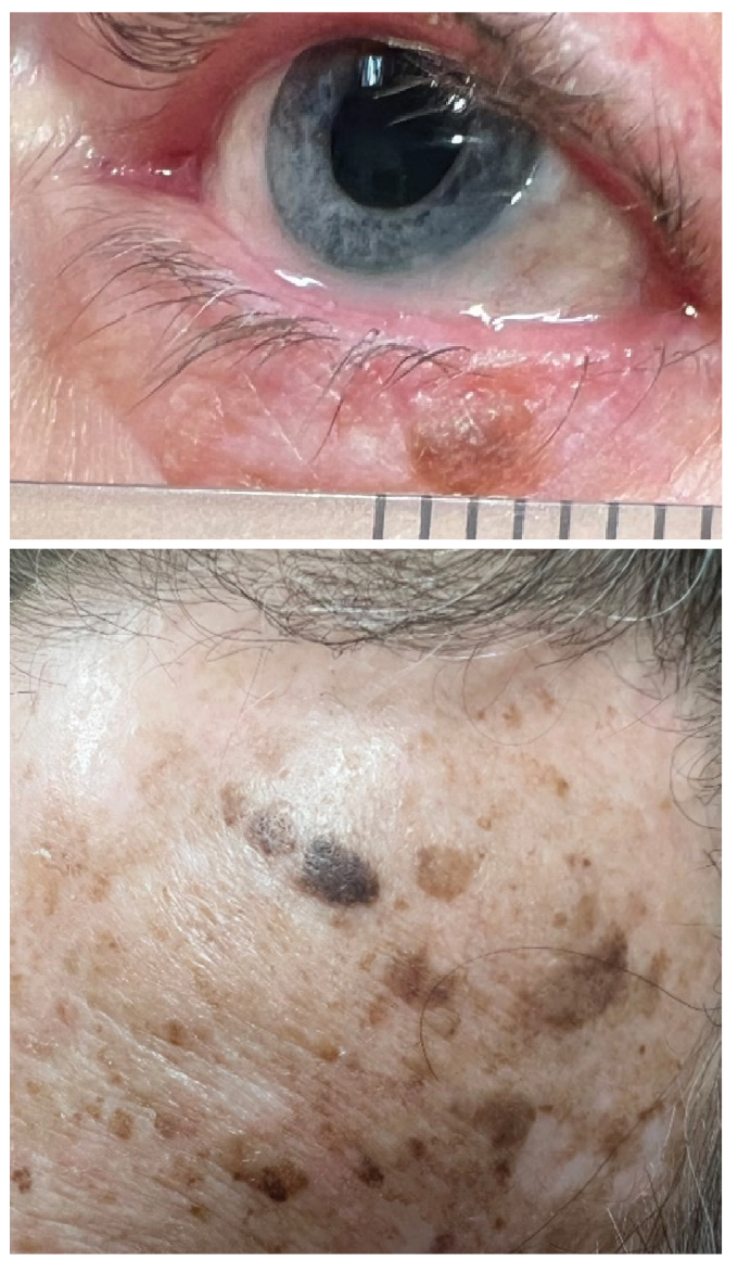 This lesion could be mistaken for a junctional nevus, demonstrating overlap in clinical characteristics. However, it was confirmed histologically to be an SK. At the bottom is an image of numerous SKs on the forehead of the same patient. 