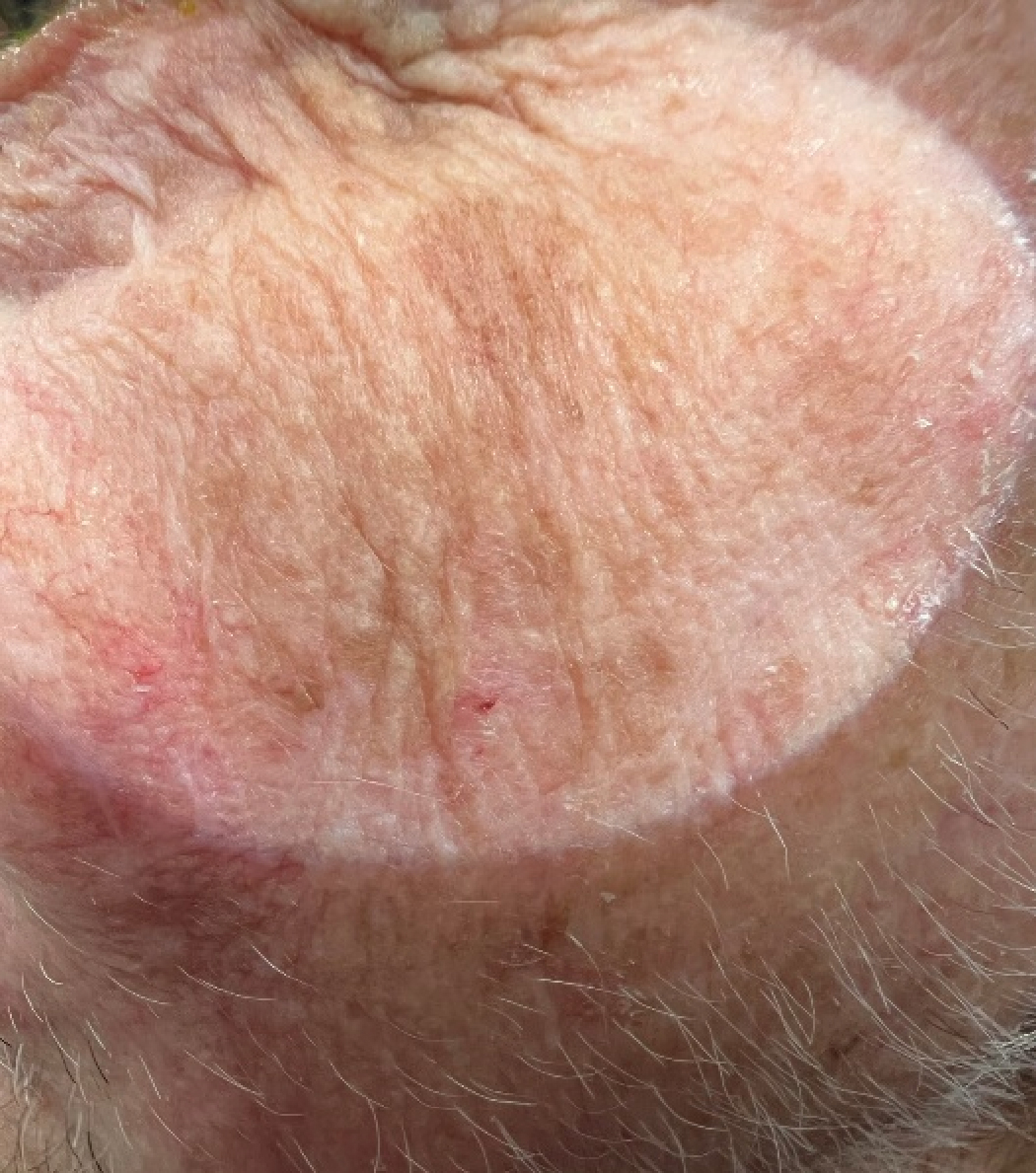 Solar lentigos and areas of actinic keratoses. These evenly hyperpigmented macules should be differentiated from the precancerous maligna, which has variable pigmentation and even more irregular borders.6 