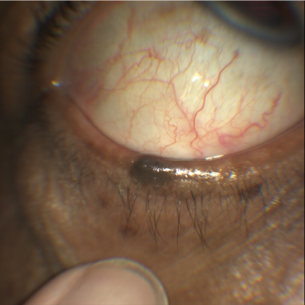 This pigmented lesion was reportedly unchanged since childhood. Note the functioning meibomian glands, normal lashes and general lack of dysplasia. We opted to photograph and monitor this and the associated small ephelides on this patient’s lower eyelid.