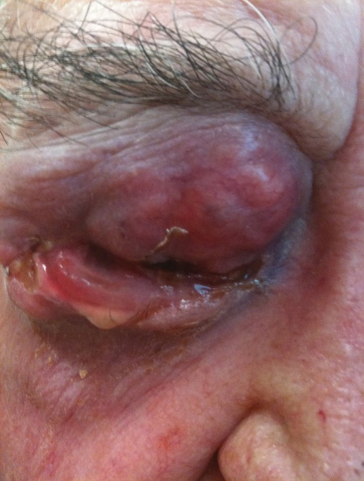 This patient presented for an eye infection. Reportedly the mass had been growing for over a year, but he and his family had not addressed it due to his poor health. The patient was commencing hospice for a terminal condition (not cancer related) and the patient, wife and their daughter refused any services specific to the tumor, requesting only antibiotics for the associated blepharoconjunctivitis.