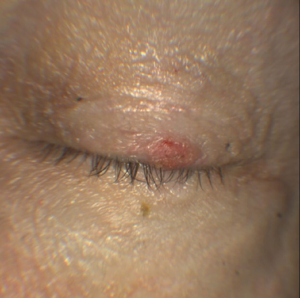 The above lesion remained after antibiotic treatment for blepharitis. The report from an oculoplastics ophthalmologist describes an inflamed SK and treated by kenalog injection.
