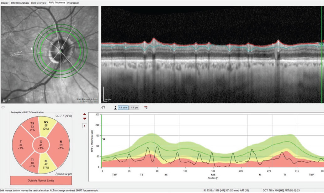 Fig. 3. Note the generalized loss of perioptic RNFL tissue in the 3.5mm diameter RNFL circle scan of the right eye; this is consistent with advanced glaucomatous disease. However, taken with the BMO-MRW scan seen in Figure 1, this does call into question the possibility of a concurrent vascular etiology of the observed damage.