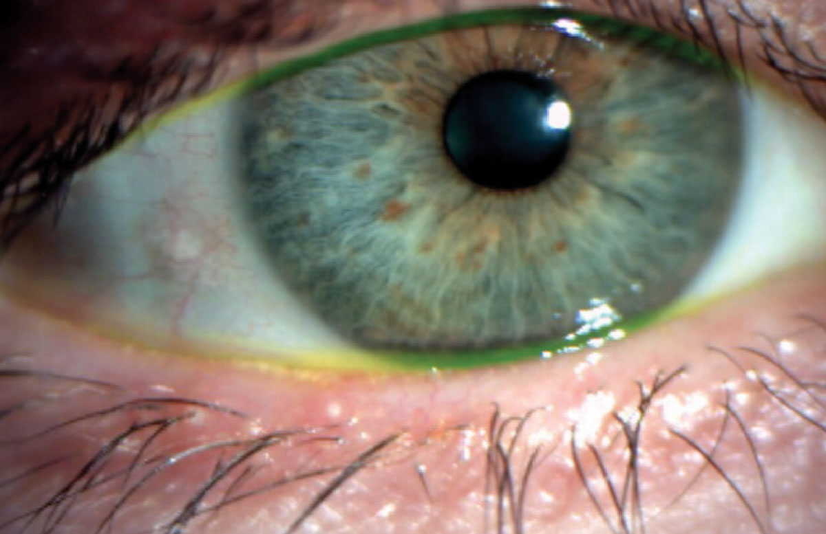 Fig. 4. Hyperkeratinization along the eyelid margin.