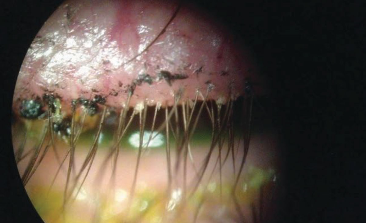This patient’s lid margins display Demodex infestation at the base of the lashes.