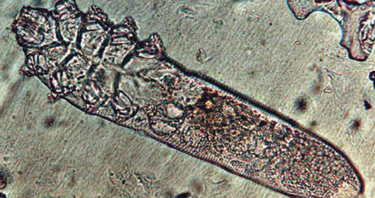 This image depicts a Demodex folliculorum mite under a microscope. While these critters can be found on the skin of most humans, an overpopulation may lead to ocular surface discomfort and require intervention.