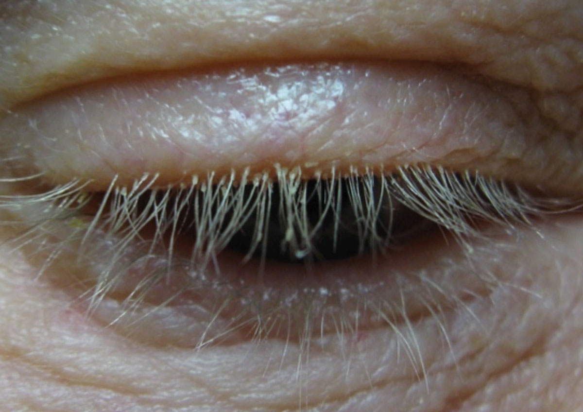 Cylindrical dandruff that presents at the base of the lashes, shown here, is a telltale sign of Demodex infestation.