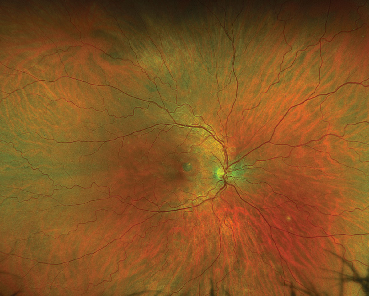 Fig. 1. Optos ultra-widefield fundus photograph of the right eye.