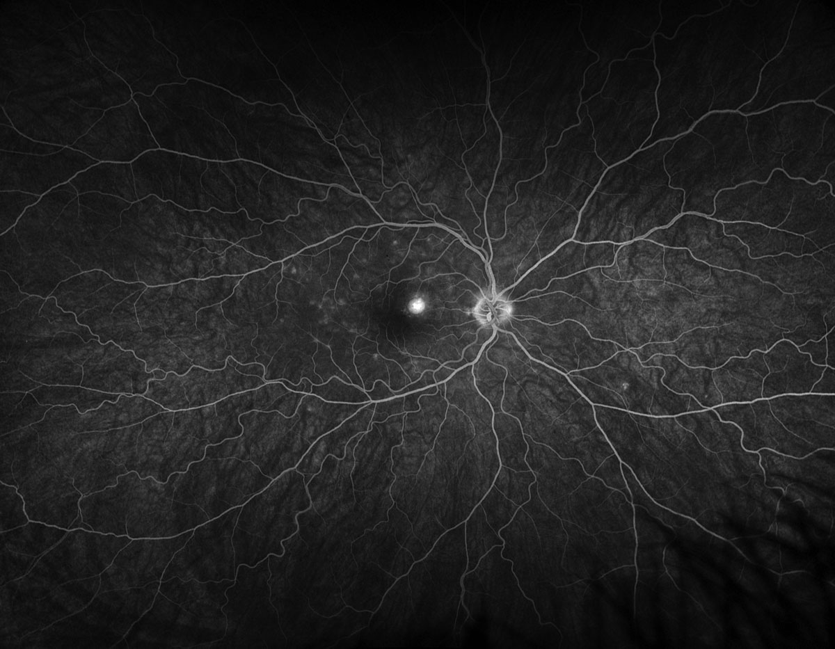 Fig. 4. Optos ultra-widefield fluorescein angiography late phase of the right eye.