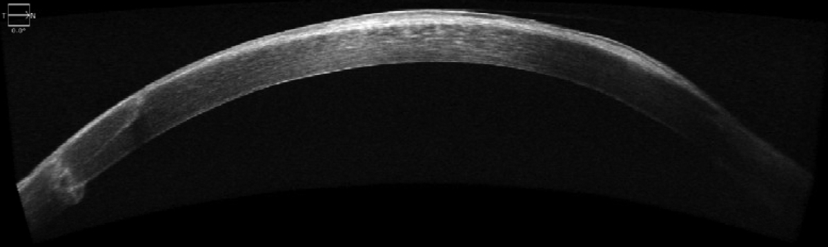 SD-OCT of the cornea following penetrating keratoplasty.