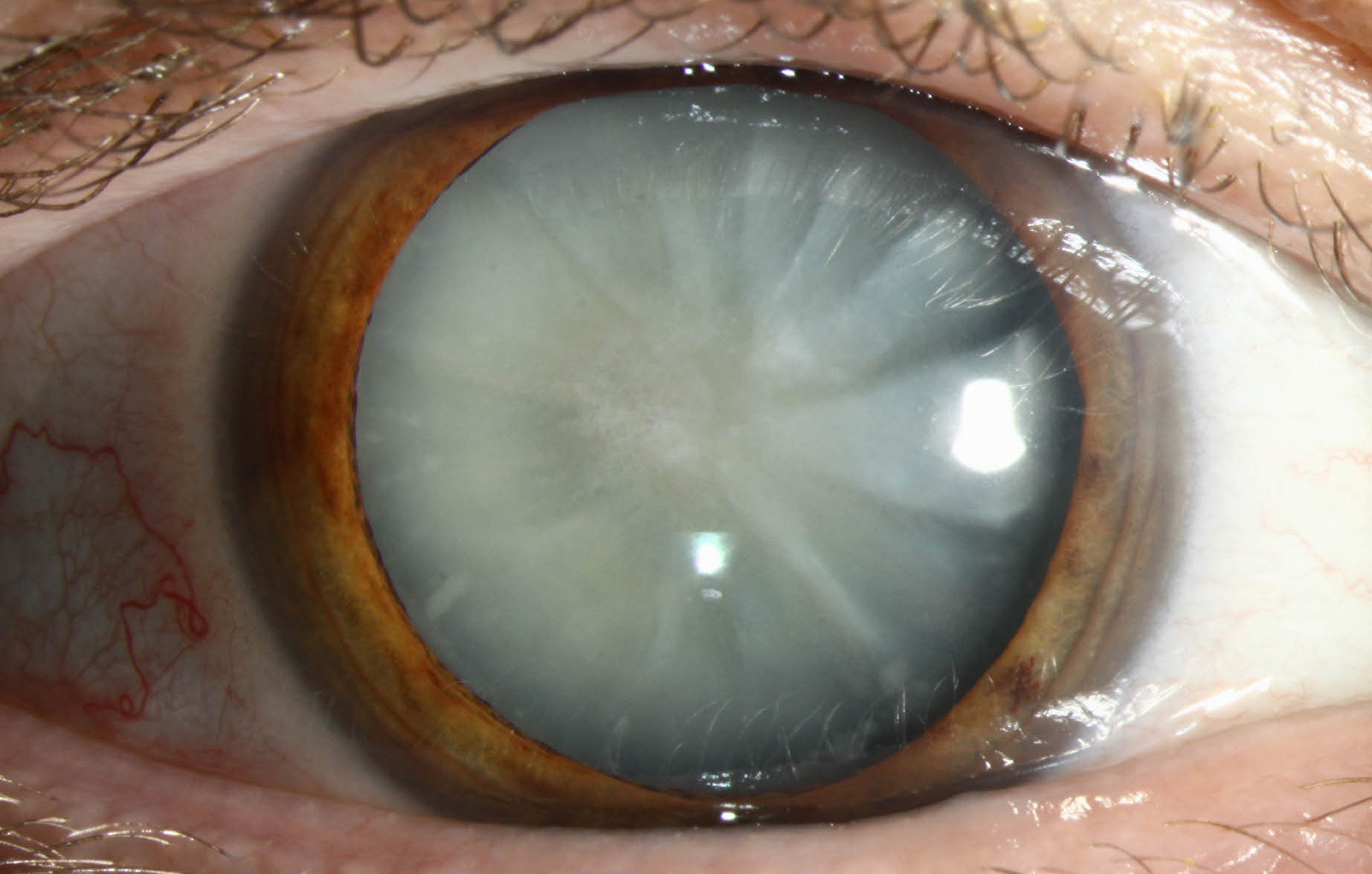 Prior to surgery, nuclear cataract patients were not as severely affected in their daily activities, while cortical and posterior subcapsular cataracts had most of the complaints related to objections with reflections, such as traffic signs, study shows.