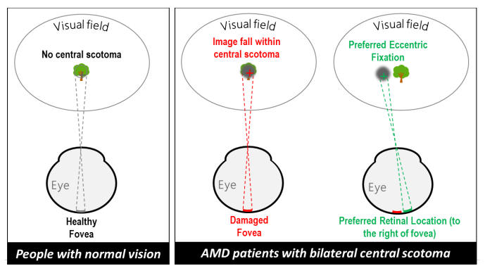 Visual acuity and contrast sensitivity deteriorated in every group, proving that rehabilitation of an inherently progressive condition such as AMD is challenging.