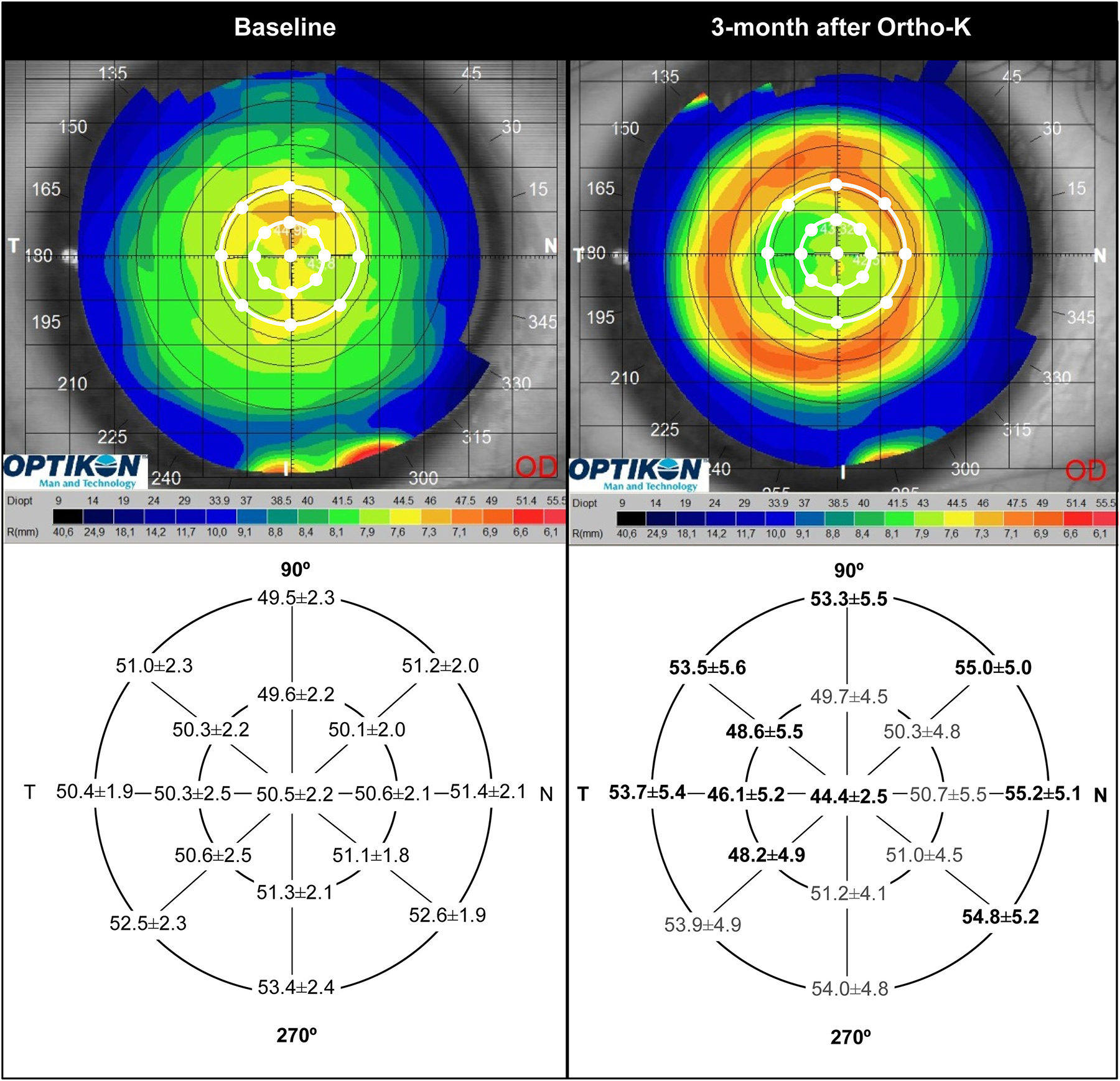 Corneal topography and epithelial thickness changes between baseline (left) and after three-month ortho-K treatment period (right). Note the stronger central and temporal epithelial thinning, and highest mid-peripheral thickening corresponding to nasal area in clear association with temporal decentration observed in this study (Figure from the study, used under Creative Commons 4.0). 